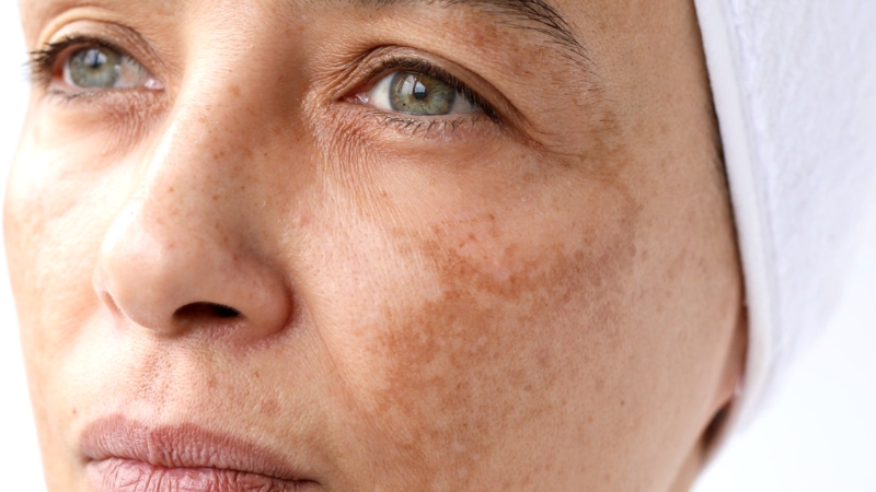 Close-up of a woman’s face showing dark spots and hyperpigmentation on the cheek area